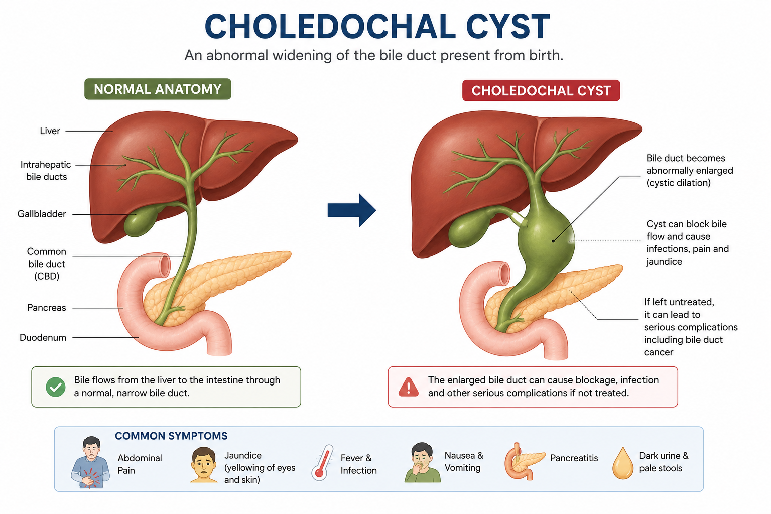 Understanding Choledochal Cyst
